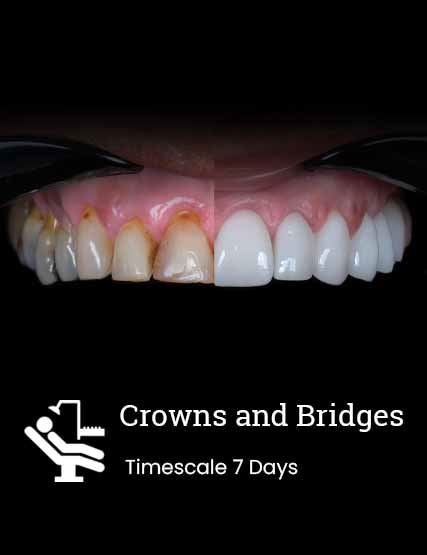 Laminate Veneer (Yakında Türkçe)