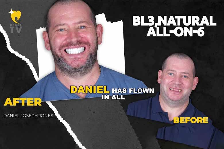 From Kent to Antalya: Daniel’s All-on-6 Dental Transformation at The Pearl Clinic (Yakında Türkçe)