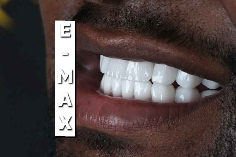 Get a Natural, Lasting Smile with E-Max Veneers in Antalya (Yakında Türkçe)
