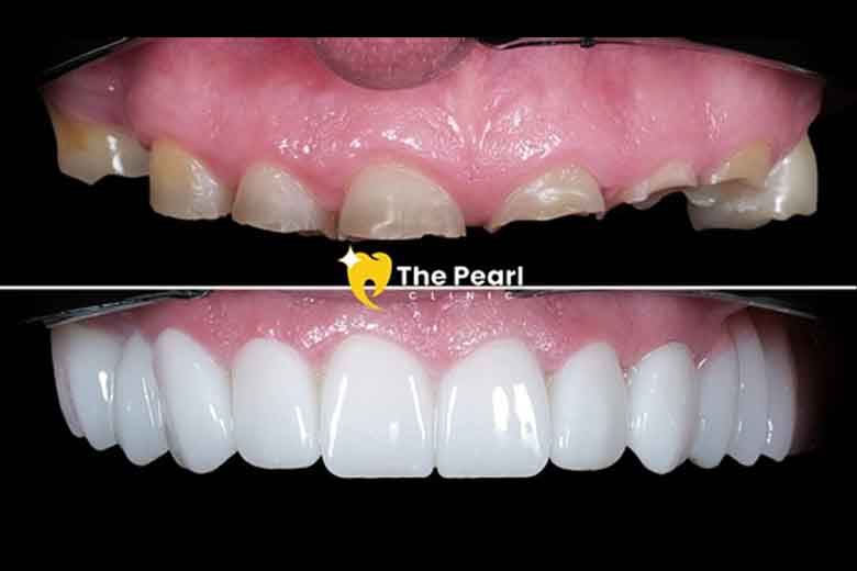 Can Worn Teeth Be Restored? Neil’s Bruxism Case Says Yes (Yakında Türkçe)